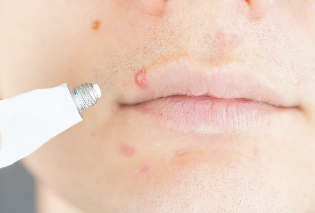 How to Get Rid of a Pimple on Your Lip - eMediHealth