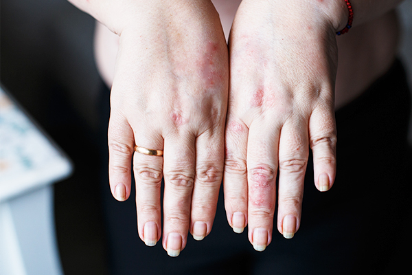 can chilblains indicate diabetes?
