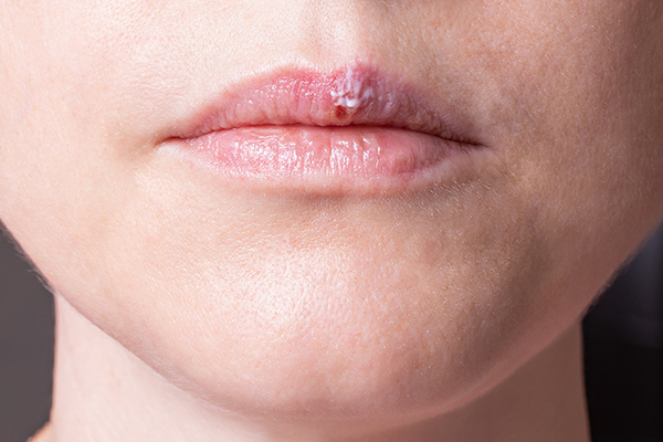 solutions for pimples around your lips