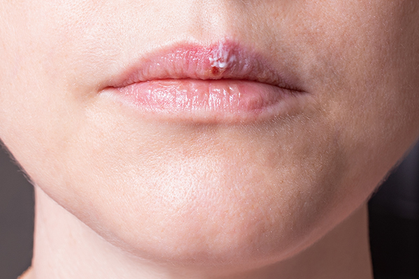 Pimple On Lip Causes Treatment And Prevention 44 Off 