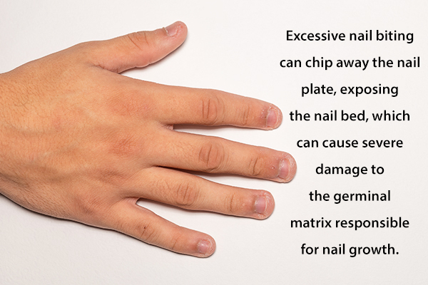 excessive nail-biting can damage the nail bed and hamper nail growth