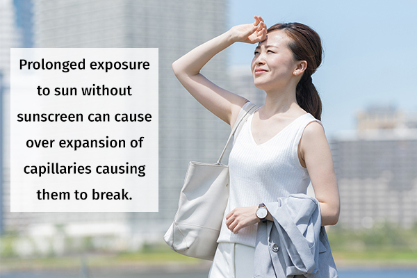 prolonged sun exposure can cause rupture of capillaries