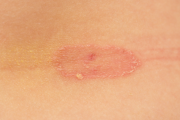 ringworm is a common fungal skin infection in children