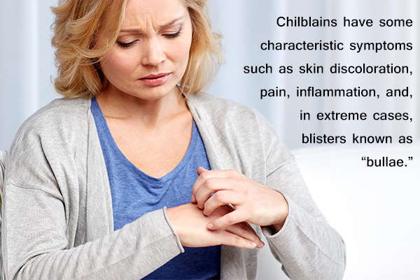 signs and symptoms of chilblains