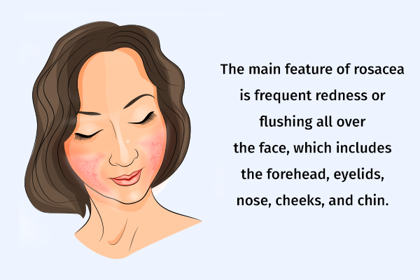 symptoms associated with rosacea