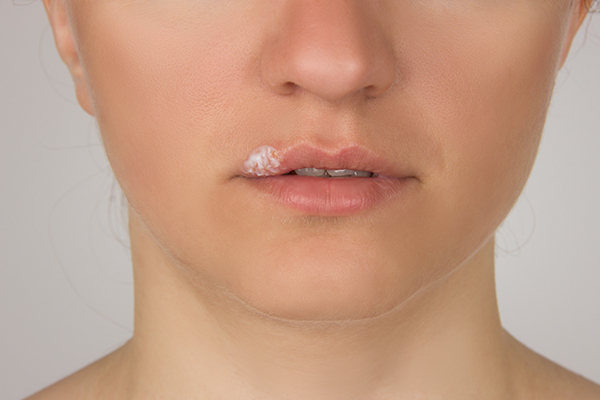 treatment modalities for pimples around your lips