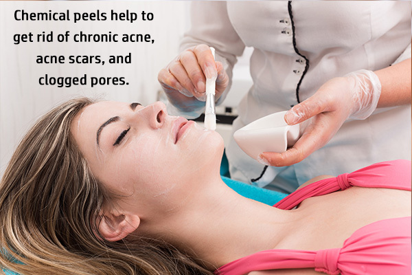chemical peels to help treat hormonal acne