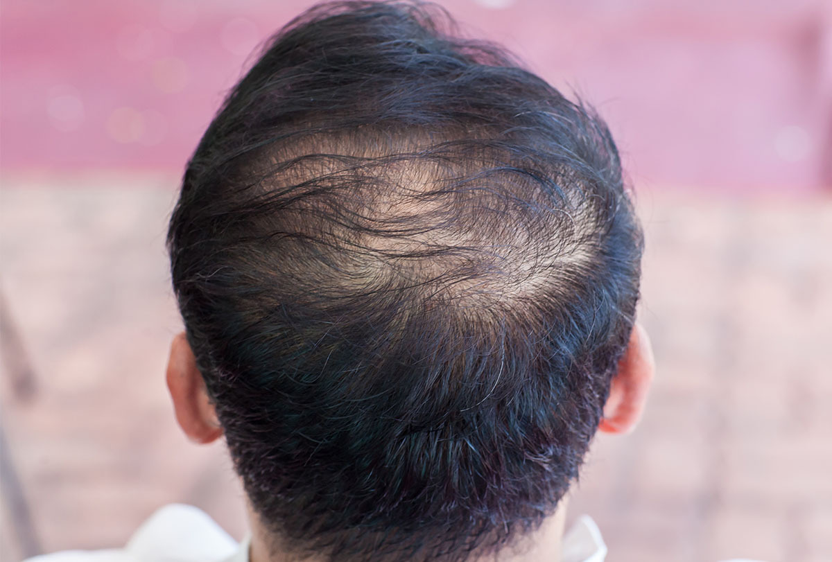 treatment and causes of hair thinning and balding