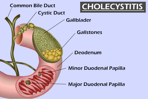 causes and types of cholecystitis