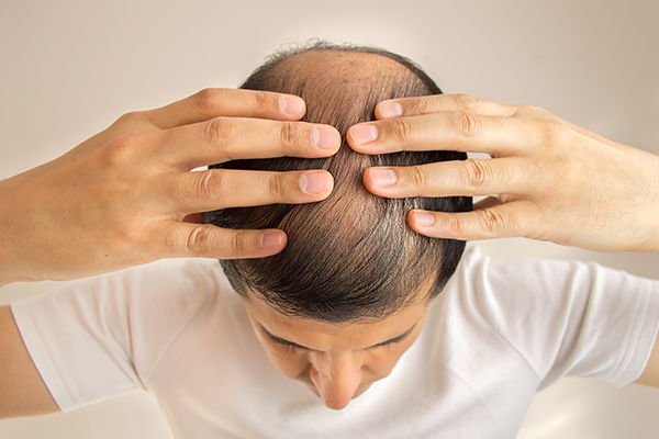 can male-pattern baldness be reversed?