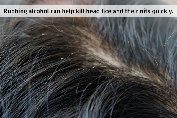 rubbing alcohol can help kill head lice