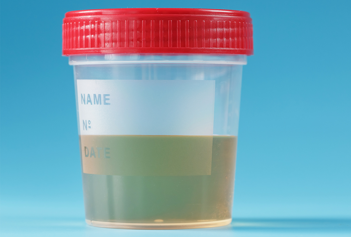 urine color cirrhosis