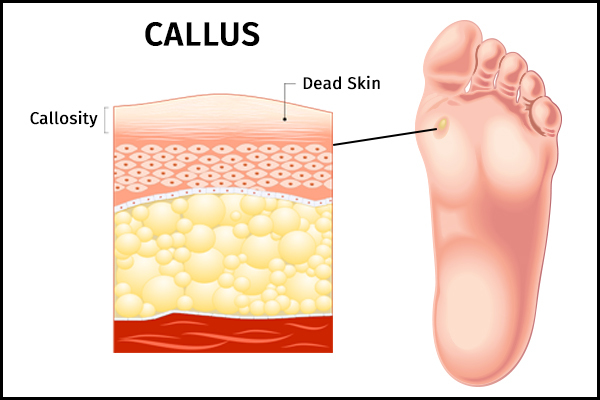 contributing factors to callus formation