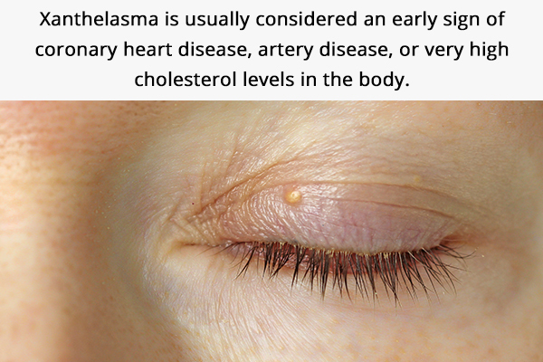can cholesterol deposits around eyes indicate coronary heart disease