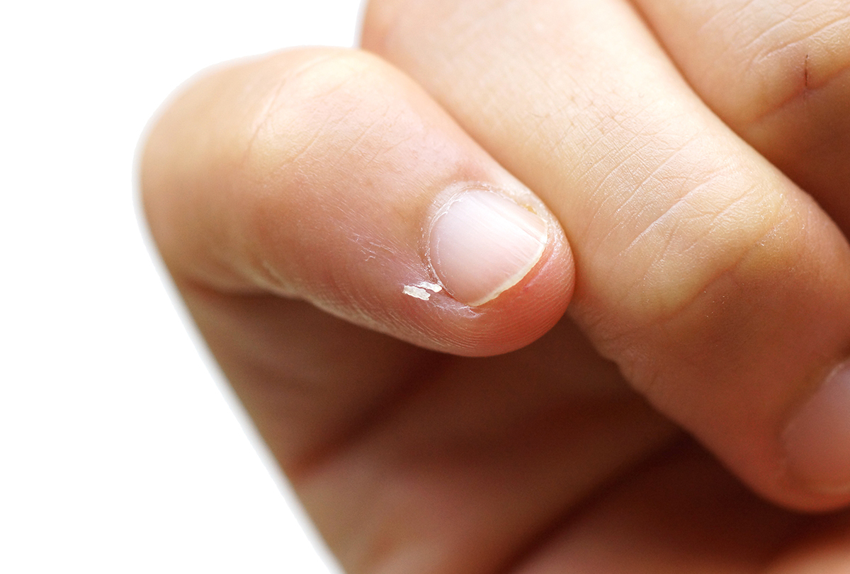 effective home remedies for hangnails