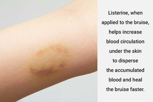 listerine can be used to help manage bruises