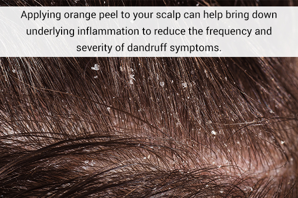 applying orange peel on scalp can help in dandruff control