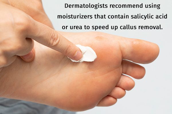 regular application of moisturizer can help remove callus removal