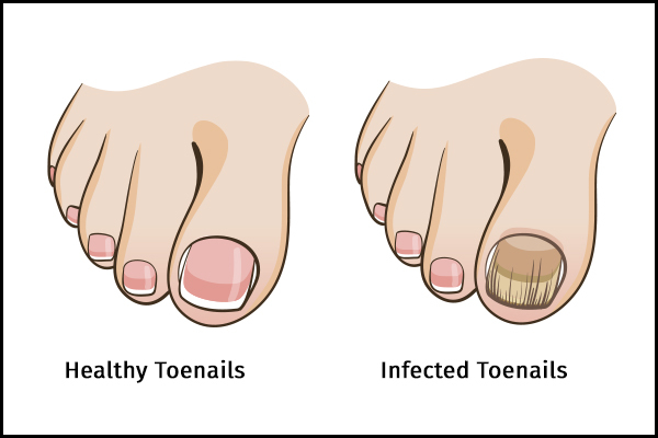 causes behind toenail fungus