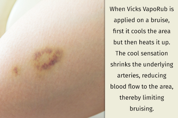 applying vicks vaporub can help in healing a bruise