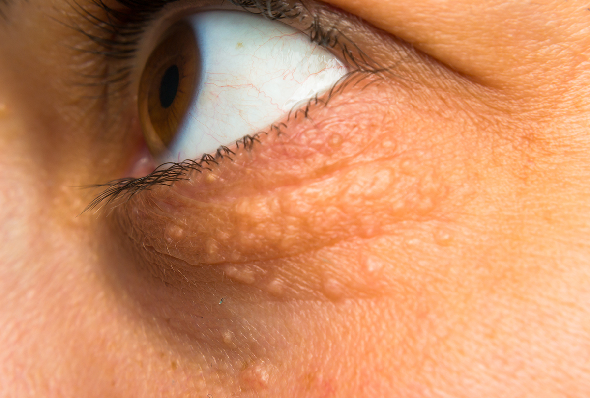 ways to treat cholesterol deposits around the eyes