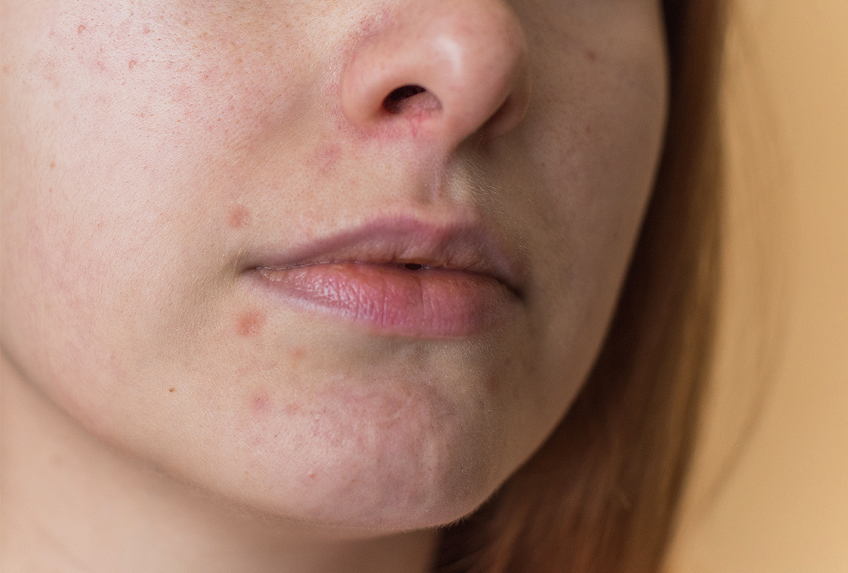 how to treat dark spots around the mouth
