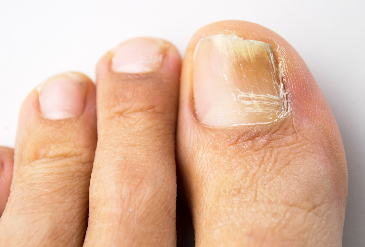 ways to manage toenail fungus