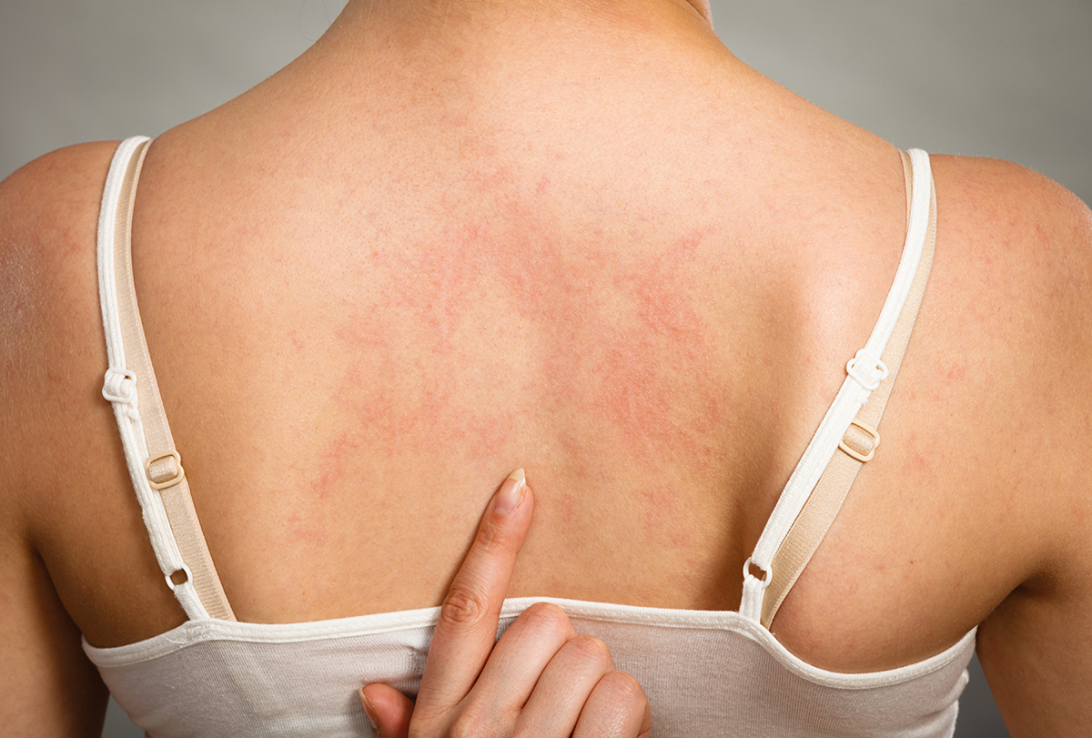 hives: causes, symptoms, and treatment options