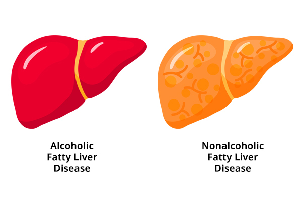 differences between alcoholic and nonalcoholic fatty liver disease
