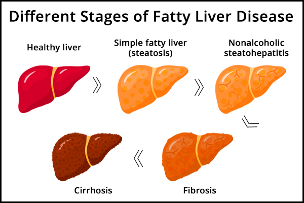 different stages of fatty liver disease