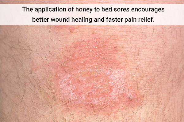 honey as a treatment for bedsores