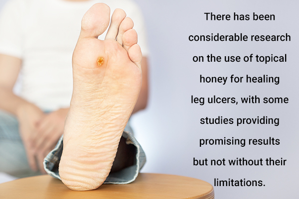 honey as a solution for leg ulcers