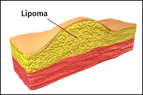 causes behind lipoma formation