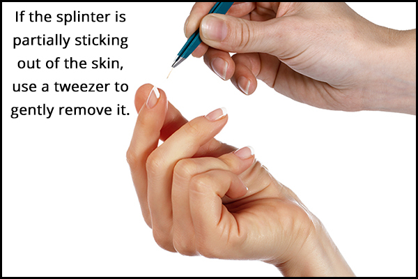 9 Ways to Remove a Splinter Safely at Home - eMediHealth