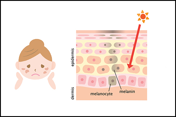 role of melanin in sun protection