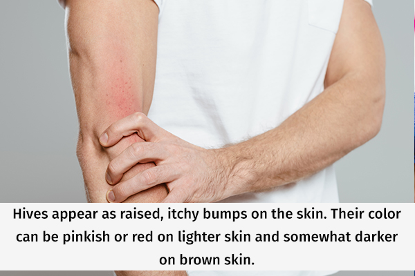 signs and symptoms of hives