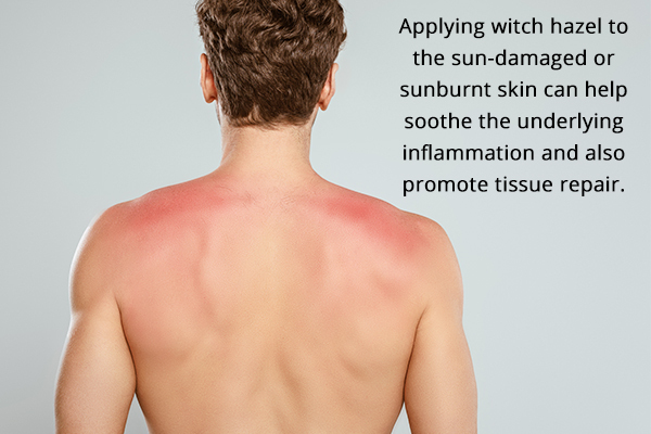 using witch hazel topically can help heal sunburn and skin damage