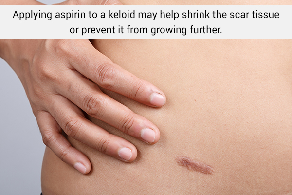 aspirin usage can help shrink keloids