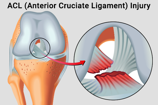 causes behind anterior cruciate ligament (ACL) injury