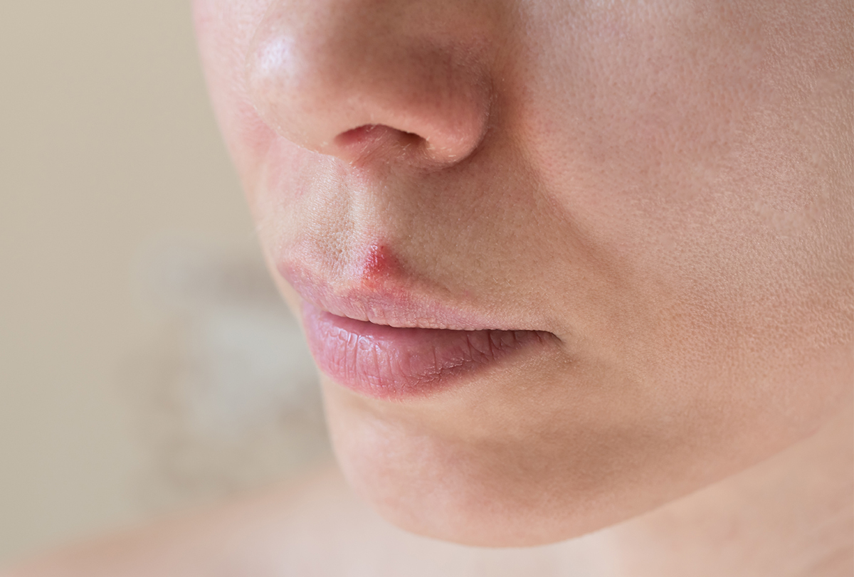 home remedies to treat cold sores