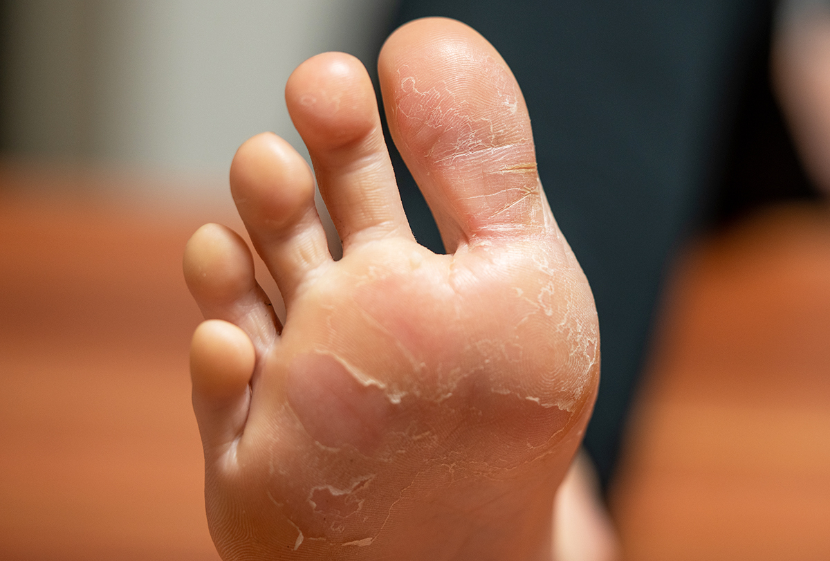 remedies for peeling skin on your feet