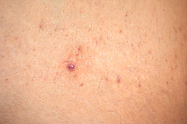 is folliculitis contagious?