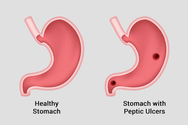 peptic ulcers possible causes