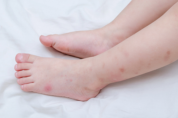 signs and symptoms of bedbug bites