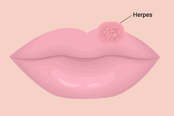 signs and symptoms of herpes