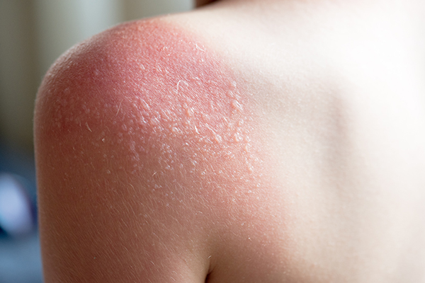 how to use your natural first-aid for soothing burns