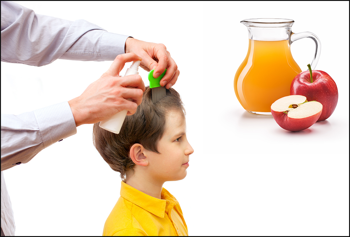 use apple cider vinegar to kill head lice