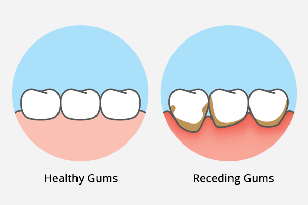 causes of gum recession
