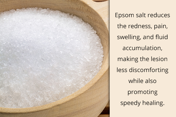 rinsing the affected area with Epsom salt can help soothe blood blisters