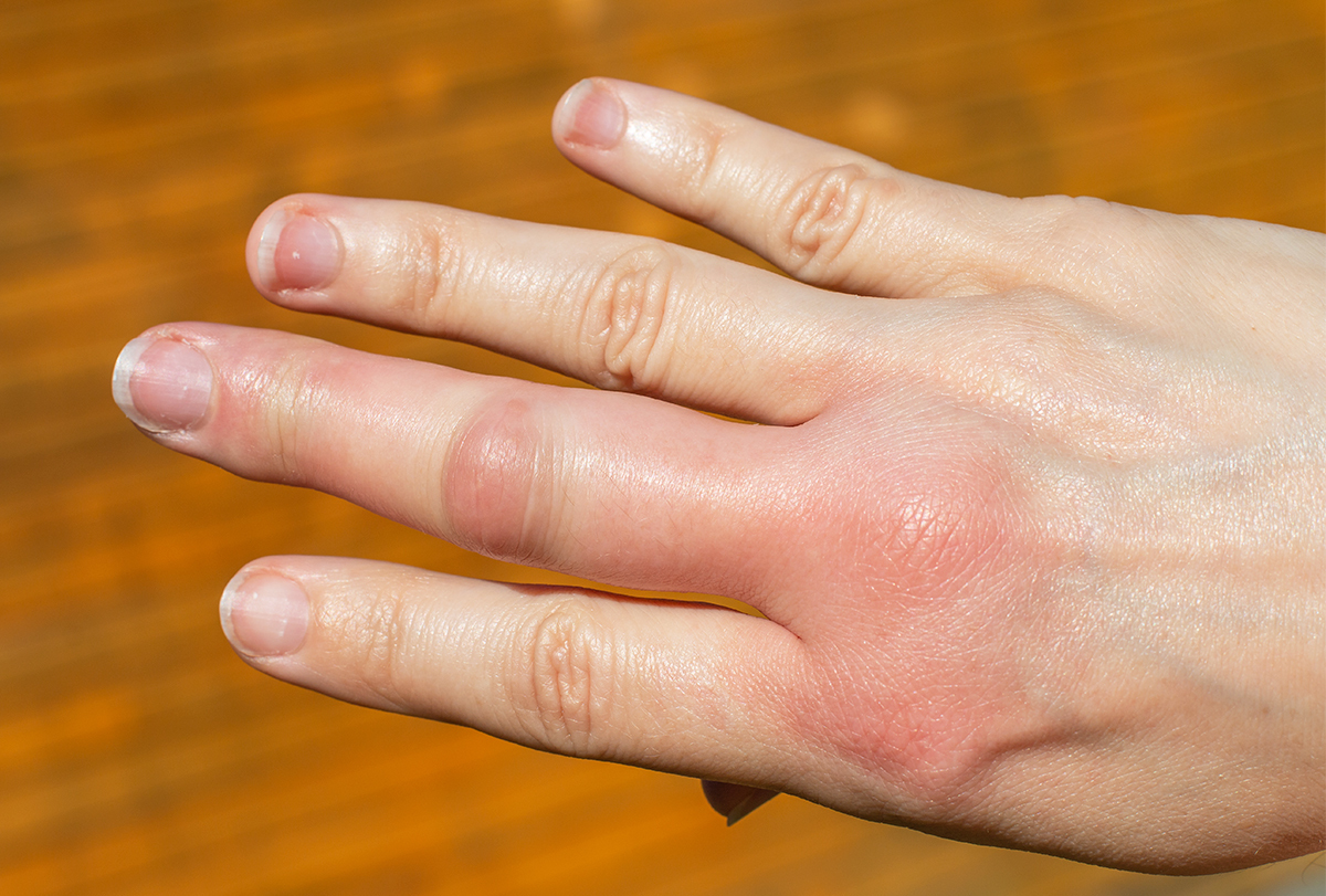 this-quick-way-to-cure-a-wasp-sting-is-hiding-in-your-kitchen-cupboard